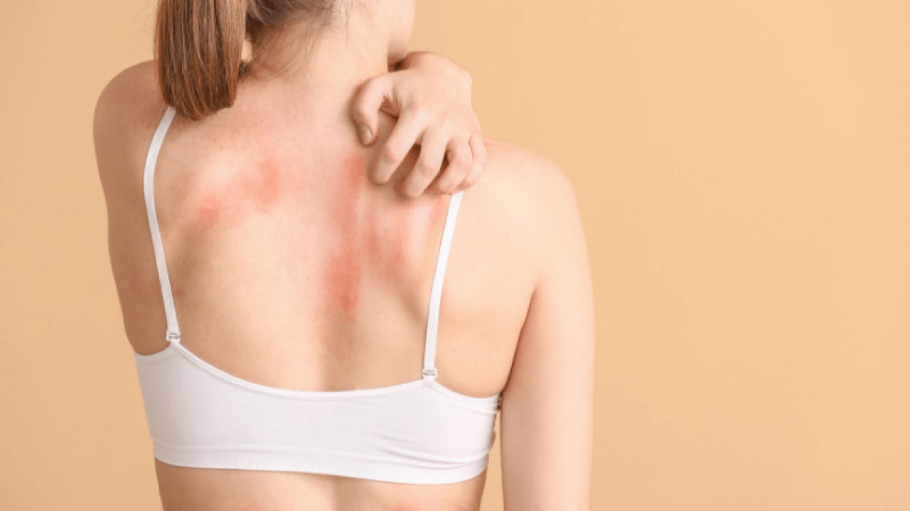 allergia-al-nichel:-sintomi-piu-comuni-e-cosa-mangiare-–-impronta-unika